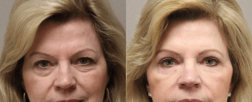 blepharoplasty before and after photos by kryger institute of plastic surgery in thousand oaks ca