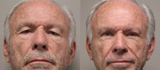 blepharoplasty before and after photos by kryger institute of plastic surgery in thousand oaks ca