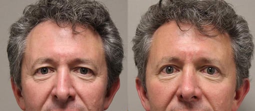 blepharoplasty before and after photos by kryger institute of plastic surgery in thousand oaks ca