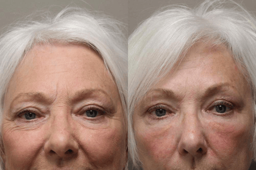 blepharoplasty before and after photos by kryger institute of plastic surgery in thousand oaks ca