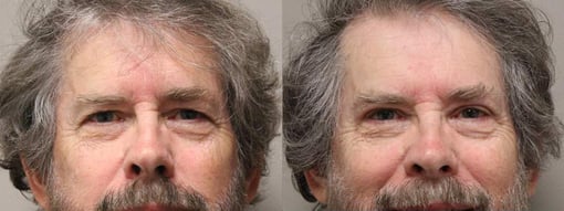 blepharoplasty before and after photos by kryger institute of plastic surgery in thousand oaks ca