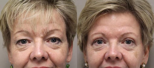 blepharoplasty before and after photos by kryger institute of plastic surgery in thousand oaks ca