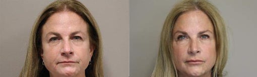 blepharoplasty before and after photos by kryger institute of plastic surgery in thousand oaks ca