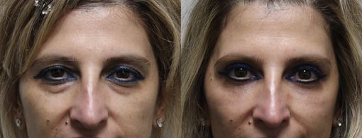 blepharoplasty before and after photos by kryger institute of plastic surgery in thousand oaks ca