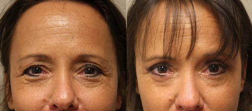 blepharoplasty before and after photos by kryger institute of plastic surgery in thousand oaks ca