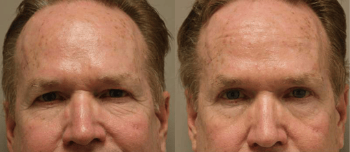 blepharoplasty before and after photos by kryger institute of plastic surgery in thousand oaks ca