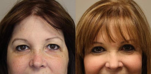 blepharoplasty before and after photos by kryger institute of plastic surgery in thousand oaks ca