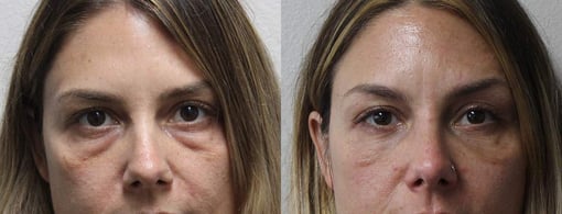 blepharoplasty before and after photos by kryger institute of plastic surgery in thousand oaks ca