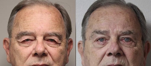 blepharoplasty before and after photos by kryger institute of plastic surgery in thousand oaks ca
