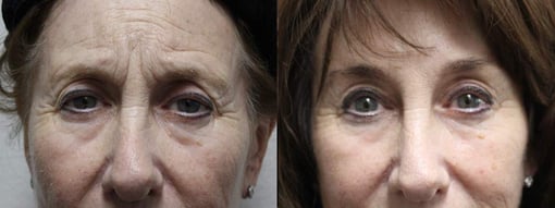 blepharoplasty before and after photos by kryger institute of plastic surgery in thousand oaks ca