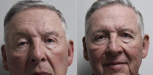 blepharoplasty before and after photos by kryger institute of plastic surgery in thousand oaks ca