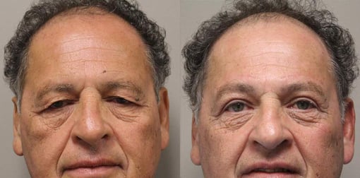 blepharoplasty before and after photos by kryger institute of plastic surgery in thousand oaks ca