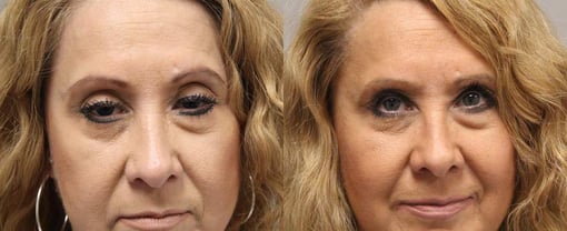 blepharoplasty before and after photos by kryger institute of plastic surgery in thousand oaks ca