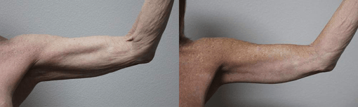 arm lift before and after photos by kryger institute of plastic surgery in thousand oaks ca