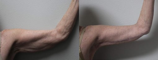 arm lift before and after photos by kryger institute of plastic surgery in thousand oaks ca