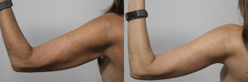 arm lift before and after photos by kryger institute of plastic surgery in thousand oaks ca