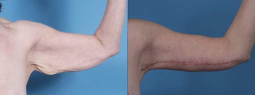arm lift before and after photos by kryger institute of plastic surgery in thousand oaks ca