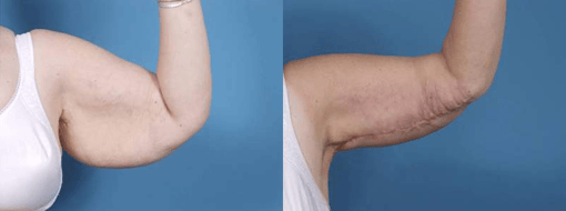 arm lift before and after photos by kryger institute of plastic surgery in thousand oaks ca
