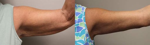 arm lift before and after photos by kryger institute of plastic surgery in thousand oaks ca
