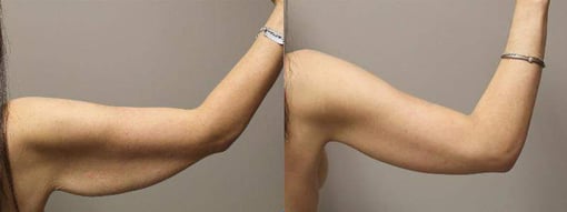arm lift before and after photos by kryger institute of plastic surgery in thousand oaks ca