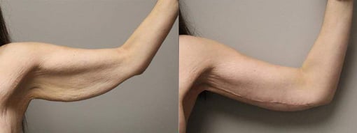 arm lift before and after photos by kryger institute of plastic surgery in thousand oaks ca