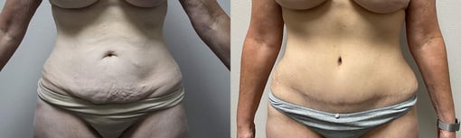 tummy tuck before and after photos by kryger institute of plastic surgery in thousand oaks ca