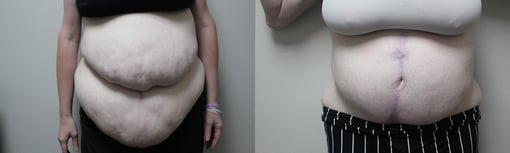 tummy tuck before and after photos by kryger institute of plastic surgery in thousand oaks ca