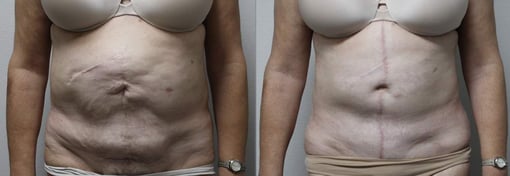 tummy tuck before and after photos by kryger institute of plastic surgery in thousand oaks ca