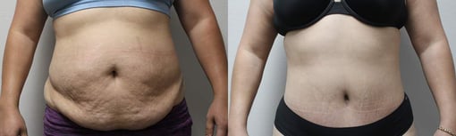 tummy tuck before and after photos by kryger institute of plastic surgery in thousand oaks ca