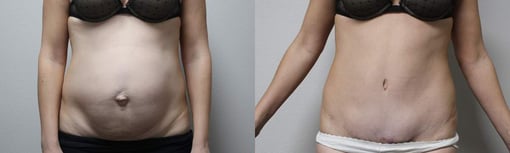 tummy tuck before and after photos by kryger institute of plastic surgery in thousand oaks ca