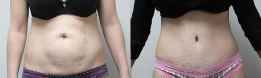 tummy tuck before and after photos by kryger institute of plastic surgery in thousand oaks ca