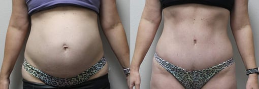tummy tuck before and after photos by kryger institute of plastic surgery in thousand oaks ca