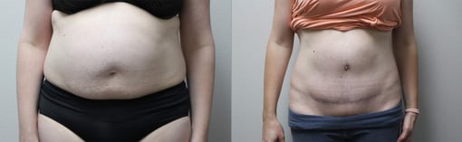 tummy tuck before and after photos by kryger institute of plastic surgery in thousand oaks ca
