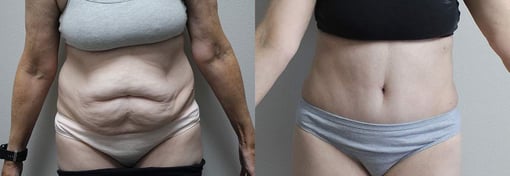 tummy tuck before and after photos by kryger institute of plastic surgery in thousand oaks ca