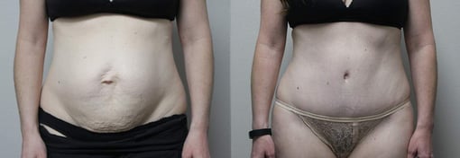 tummy tuck before and after photos by kryger institute of plastic surgery in thousand oaks ca