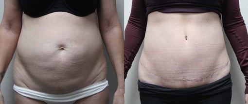 tummy tuck before and after photos by kryger institute of plastic surgery in thousand oaks ca