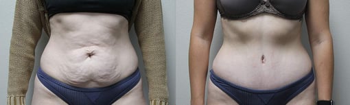 tummy tuck before and after photos by kryger institute of plastic surgery in thousand oaks ca