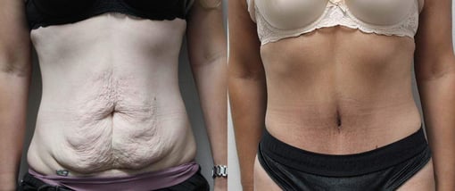 tummy tuck before and after photos by kryger institute of plastic surgery in thousand oaks ca