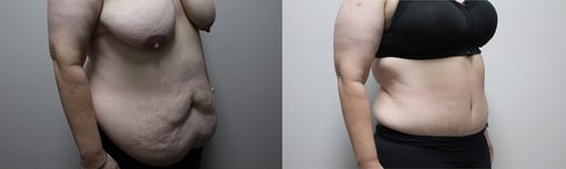 tummy tuck before and after photos by kryger institute of plastic surgery in thousand oaks ca