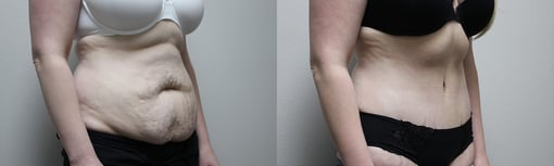 tummy tuck before and after photos by kryger institute of plastic surgery in thousand oaks ca