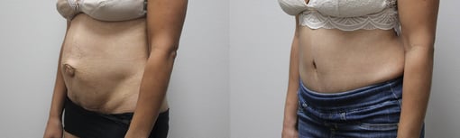 tummy tuck before and after photos by kryger institute of plastic surgery in thousand oaks ca