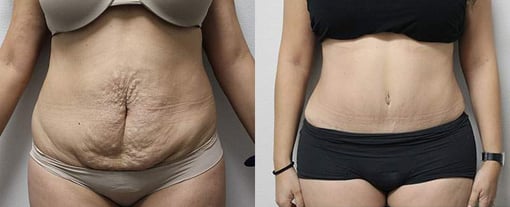 tummy tuck before and after photos by kryger institute of plastic surgery in thousand oaks ca