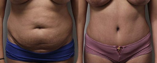 tummy tuck before and after photos by kryger institute of plastic surgery in thousand oaks ca