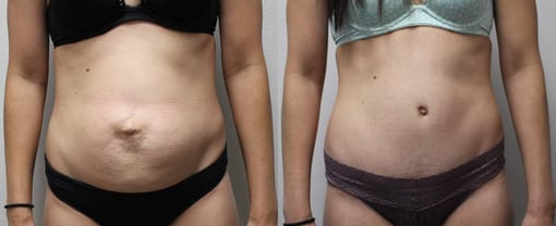 tummy tuck before and after photos by kryger institute of plastic surgery in thousand oaks ca