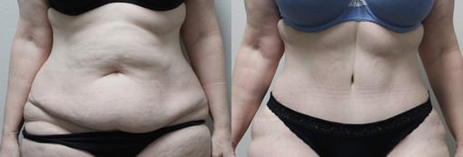 tummy tuck before and after photos by kryger institute of plastic surgery in thousand oaks ca