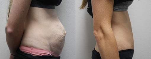 tummy tuck before and after photos by kryger institute of plastic surgery in thousand oaks ca