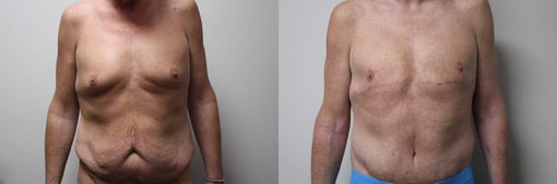 tummy tuck before and after photos by kryger institute of plastic surgery in thousand oaks ca