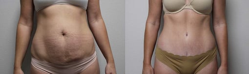 tummy tuck before and after photos by kryger institute of plastic surgery in thousand oaks ca