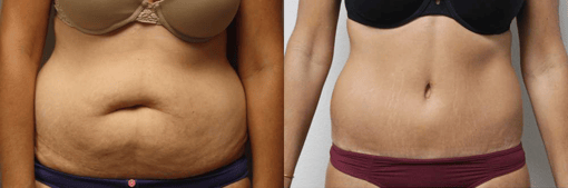 tummy tuck before and after photos by kryger institute of plastic surgery in thousand oaks ca