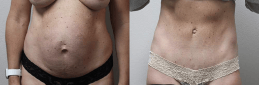 tummy tuck before and after photos by kryger institute of plastic surgery in thousand oaks ca